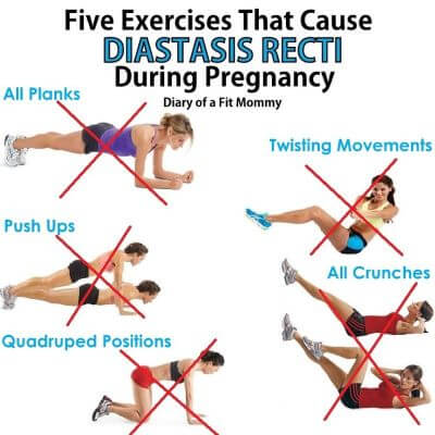 Exercises can cause Diastasis Recti during pregnancy