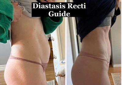 Diastasis Recti Exercises results